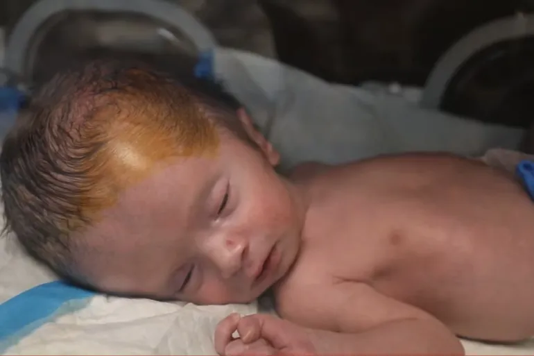 Gaza’s unseen casualties: A surge in stillbirths and birth defects