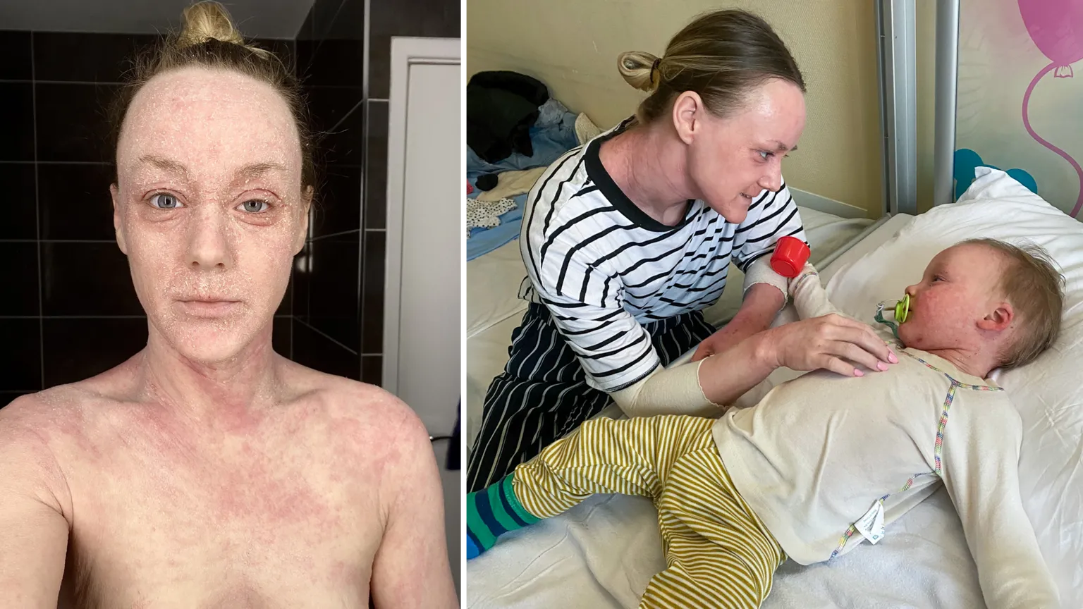 Hundreds contact BBC about mystery skin condition 'hell' - but doctors can't agree it exists