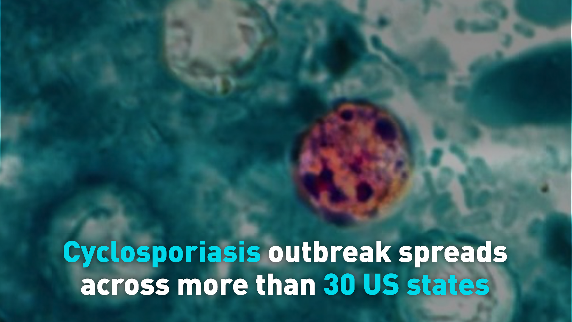 Cyclosporiasis outbreak spreads across more than 30 US states