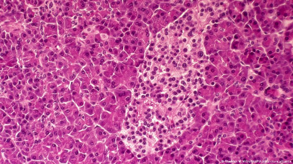 Pancreatic cancer: New drug extends lives but isn't a cure
