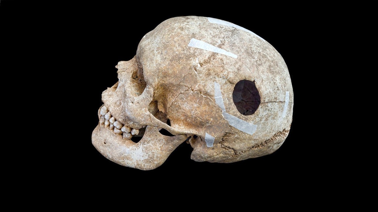 Archaeologists uncover evidence of early brain surgery on 9th-century man