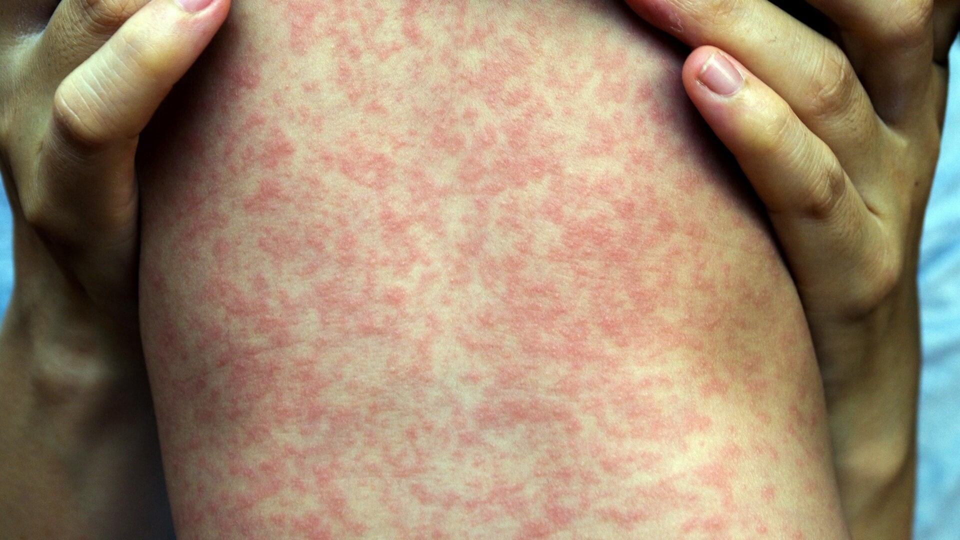 Measles Outbreak in South Carolina Linked to Brain Swelling in Kids