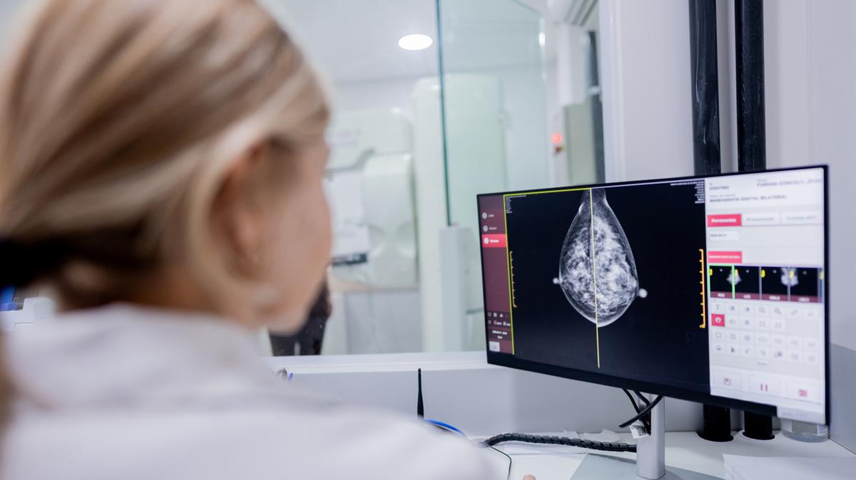 L’AI vede il tumore al seno fino a 6 anni prima. “Straordinario, ma no a sovratrattamenti”. I rischi dell’eccesso diagnostico