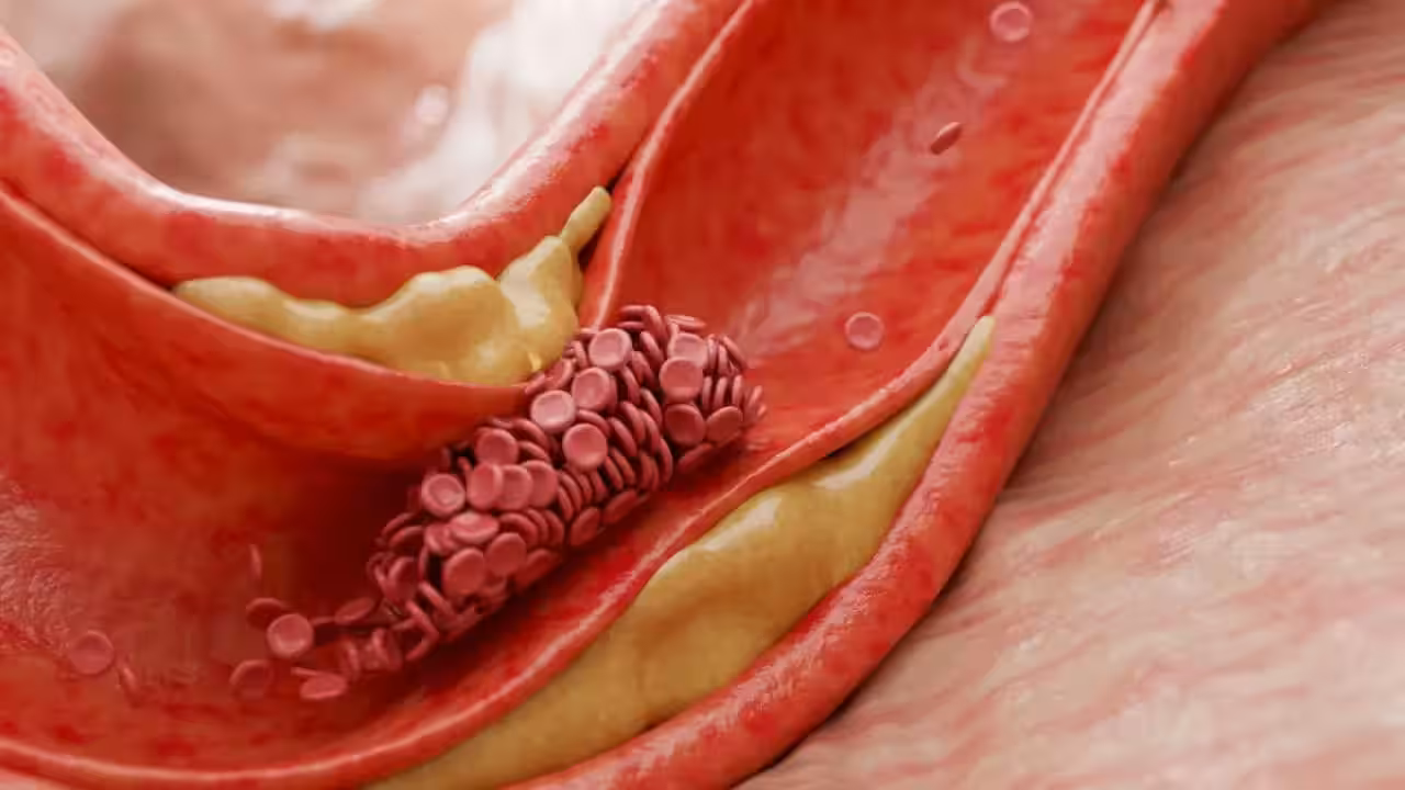 Gut microbe makes molecule that cuts cholesterol and shrinks arterial plaque, study finds