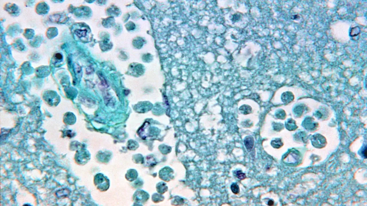 Another brain-eating amoeba case leaves teen critically ill