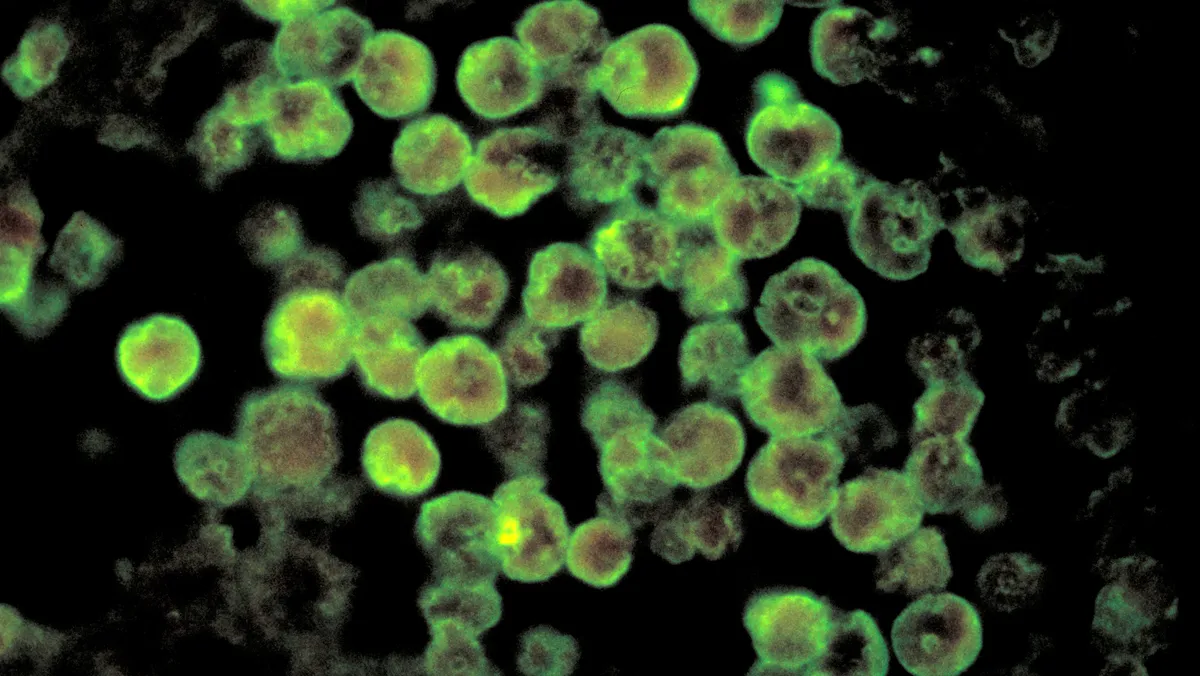 Teen in North Carolina dies after contracting brain-eating amoeba