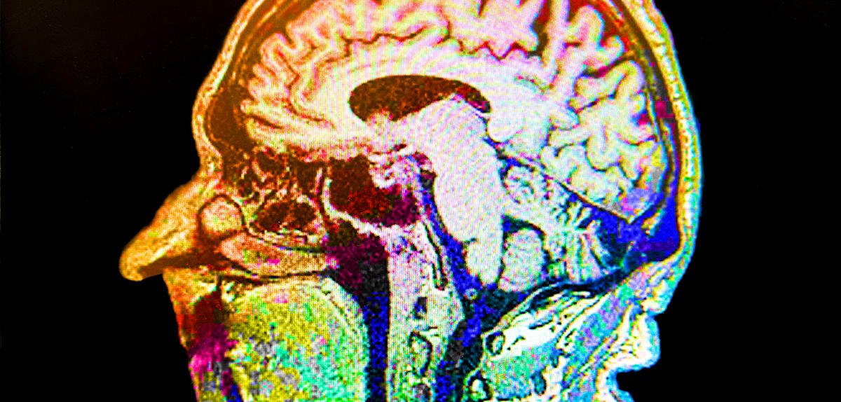 Alzheimer-Patientin erlangt nach Einnahme von halluzinogenen Pilzen Erinnerungen zurück