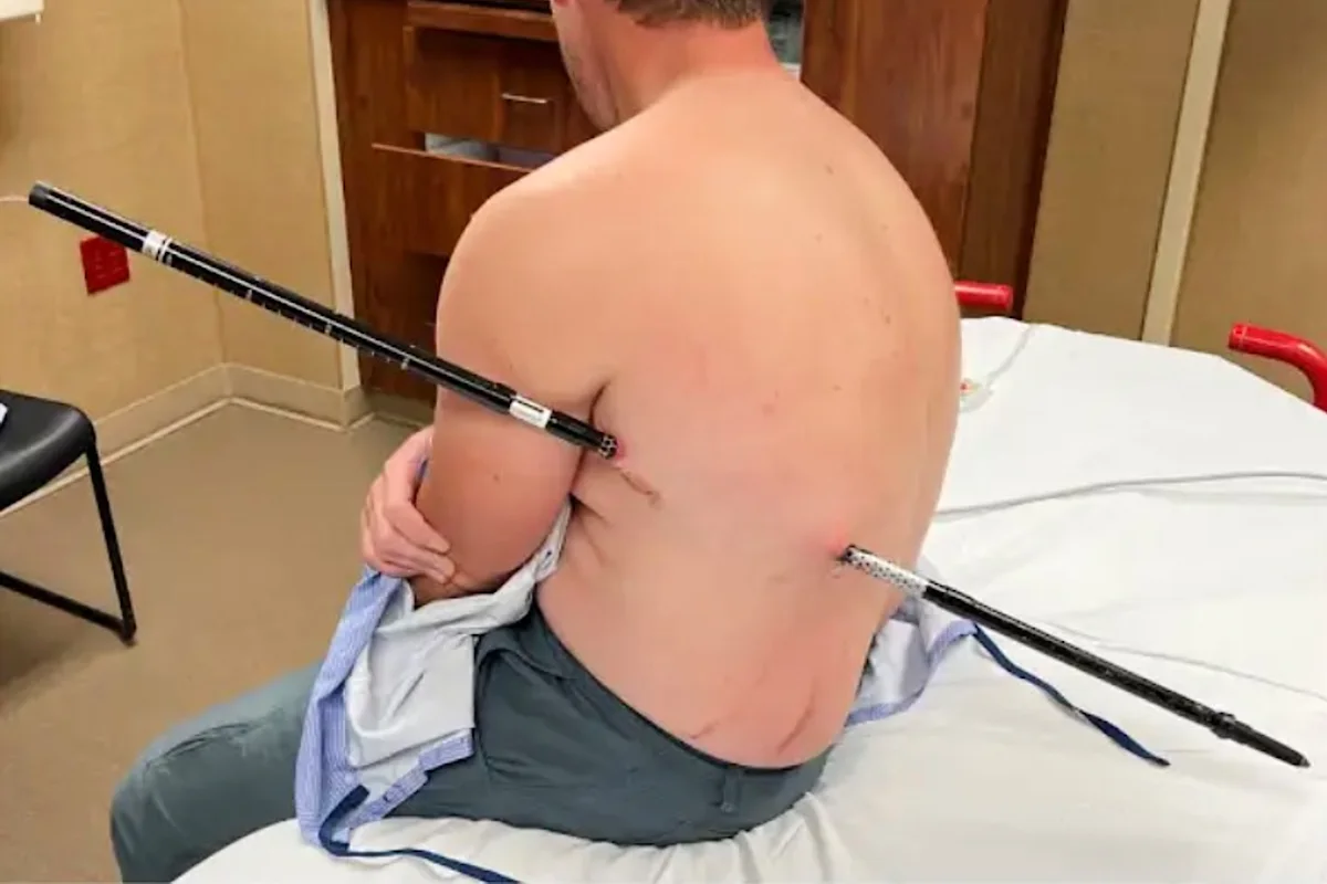 Montana man hikes out of the mountains to get help after he was impaled by a trekking pole