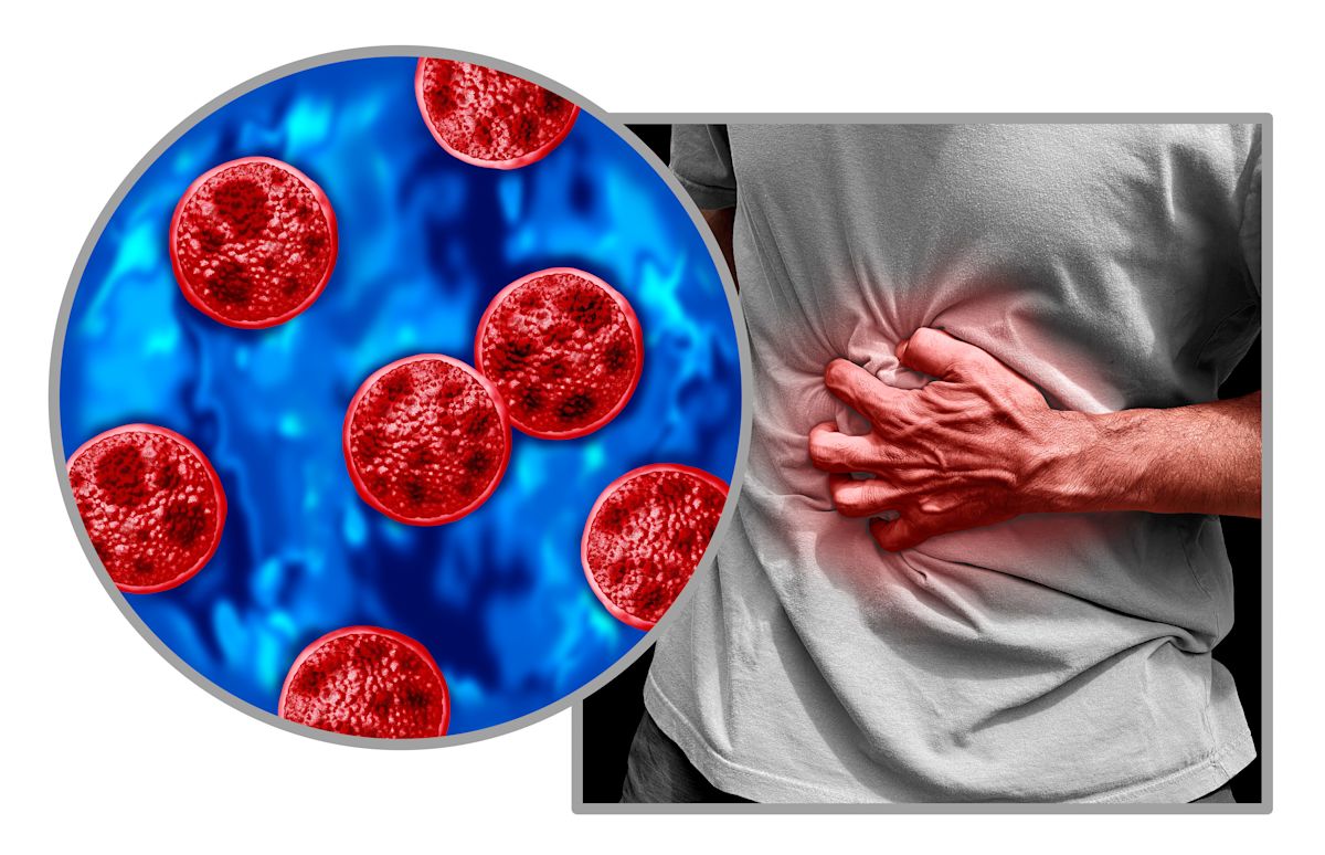 Philadelphia health officials report 25 cyclosporiasis cases this year
