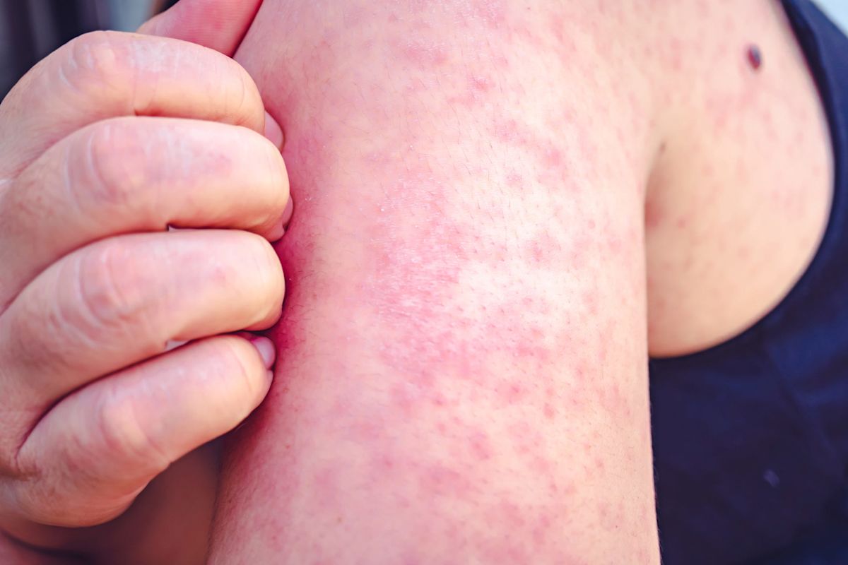 Pennsylvania measles deaths raise concerns for Pittsburgh as school year begins