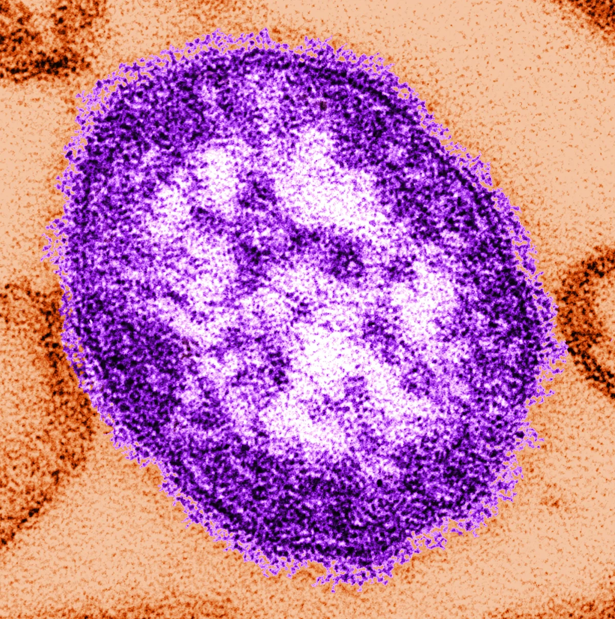 Pennsylvania reports sixth measles-associated death in ongoing outbreak